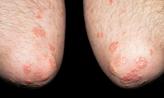 TUBERØSE XANTOMER PÅ ALBUER: Mer sjelden variant. Foto: NTB Scanpix/Shutterstock TUBERØSE XANTOMER PÅ ALBUER: Mer sjelden variant. Foto: NTB Scanpix/Shutterstock